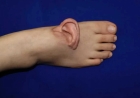 Severed Ear Grafted to Foot and Reattached in China | Medical Marvel