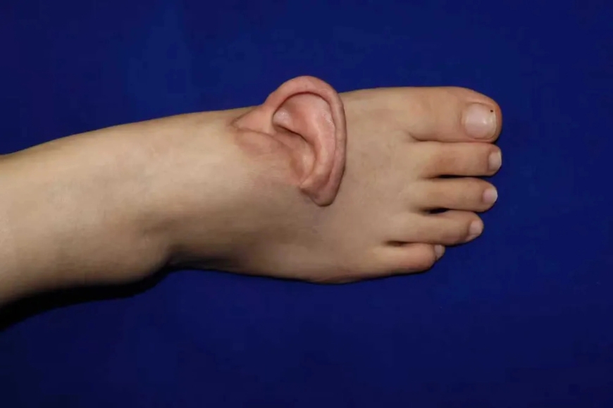 Severed Ear Grafted to Foot and Reattached in China | Medical Marvel